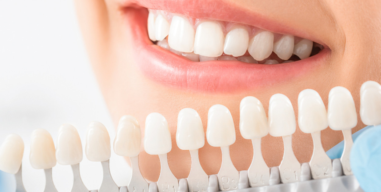 Bonding zębów - szybki sposób na piękny uśmiech w Gdańsku