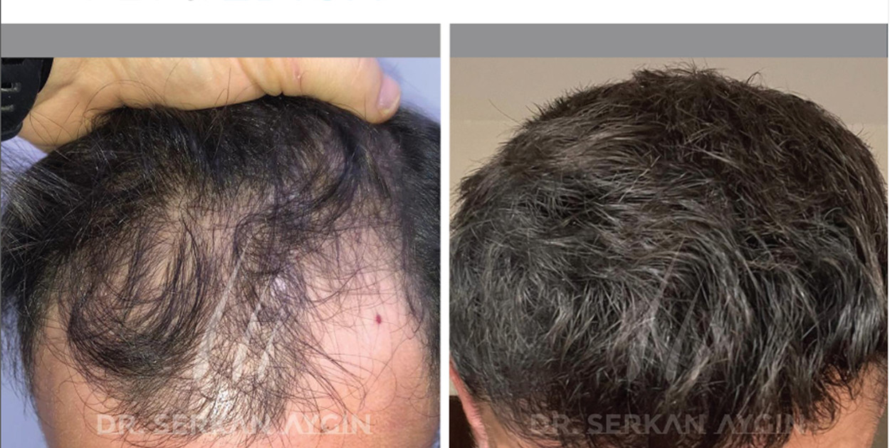 Skąd się biorą zakola i jak się ich pozbyć? Porady Flymedica