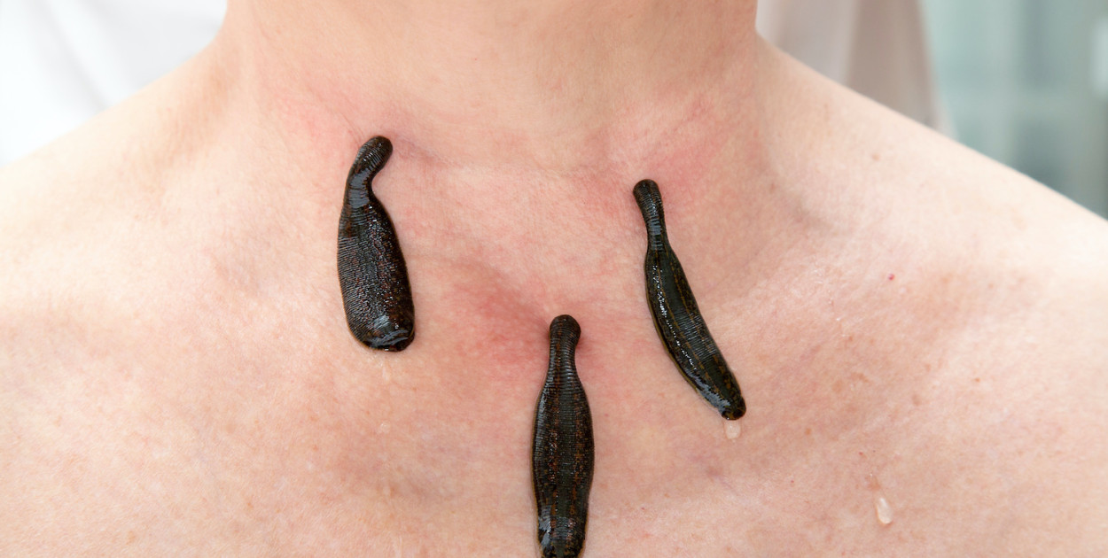 Czy hirudoterapia pomaga w leczeniu przerostu prostaty?